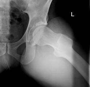 Atrapamiento Femoroacetabular