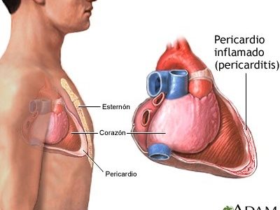 “Transtornos del pericardio” por Alicia y Leticia Beker.